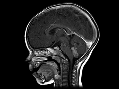 Cancer cell：儿童脑瘤治疗的新靶点