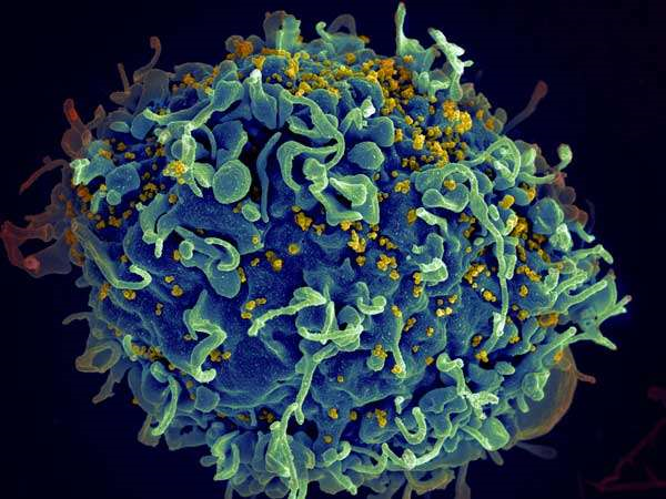 JAMA：比较几种检测HIV急性感染方法的性能