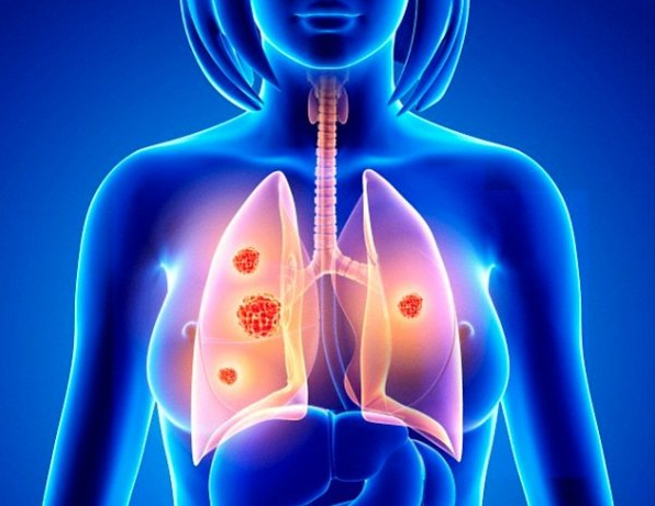 碳水化合物食物吃多了会患肺癌？威斯腾生物2.png