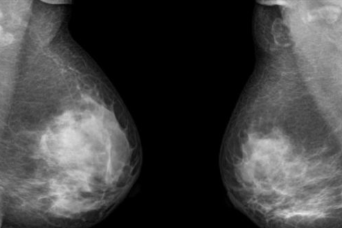 双乳房切除术人数10年涨3倍 乳腺癌患者存活率几无变化
